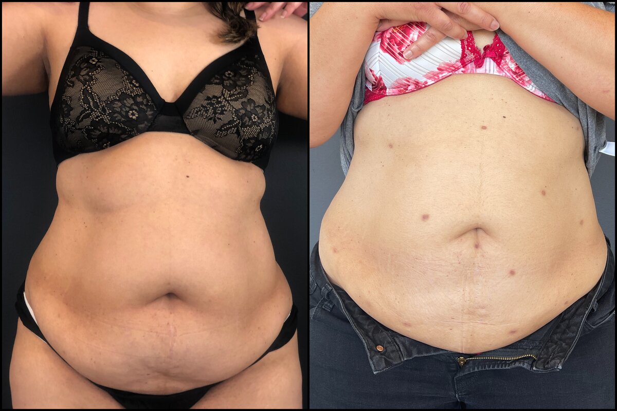 Laser Liposuction - Abdomen (Front View) Before and After